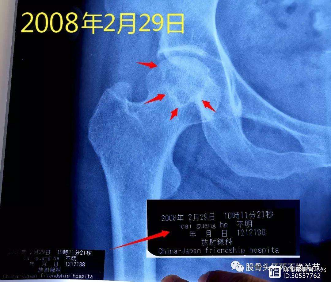保定人工骨头医保报销多少(人工骨头医保报销多少比例)